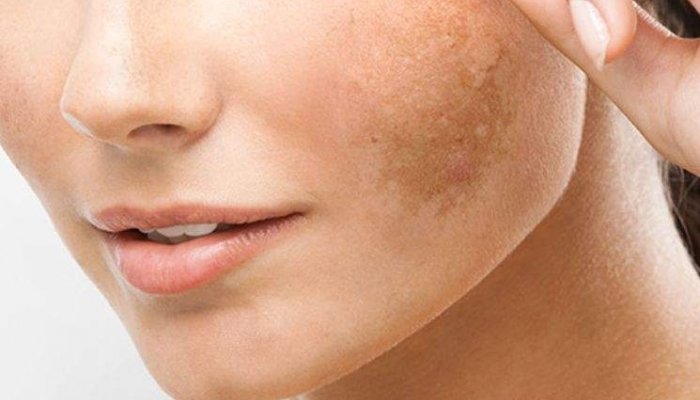 melasma.jpg